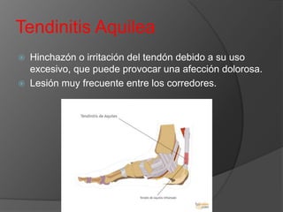 Tendinitis Aquilea
Hinchazón o irritación del tendón debido a su uso
excesivo, que puede provocar una afección dolorosa.
 Lesión muy frecuente entre los corredores.


 
