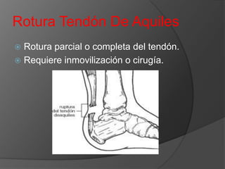 Rotura Tendón De Aquiles
Rotura parcial o completa del tendón.
 Requiere inmovilización o cirugía.


 