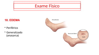 Exame Físico
10. EDEMA
• Periférico
• Generalizado
(anasarca)
 