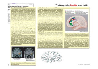 32 dr. gino martorelli
TristezzaTristezza nellanella PerditaPerdita e nele nel LuttoLutto
 