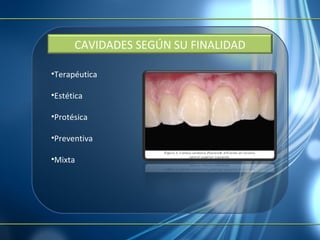 Terapéutica Estética Protésica Preventiva Mixta CAVIDADES SEGÚN SU FINALIDAD 
