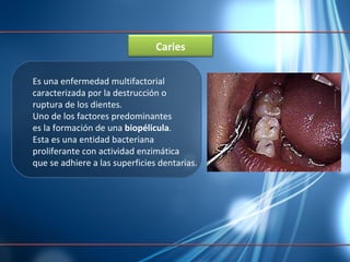 Es una enfermedad multifactorial  caracterizada por la destrucción o  ruptura de los dientes.  Uno de los factores predominantes  es la formación de una  biopélicula .  Esta es una entidad bacteriana  proliferante con actividad enzimática  que se adhiere a las superficies dentarias. Caries 