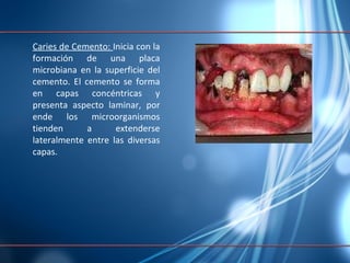 Caries de Cemento:  Inicia con la formación de una placa microbiana en la superficie del cemento. El cemento se forma en capas concéntricas y presenta aspecto laminar, por ende los microorganismos tienden a extenderse lateralmente entre las diversas capas. 
