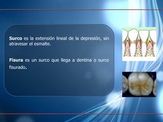 Surco  es la extensión lineal de la depresión, sin atravesar el esmalte. Fisura  es un  surco que llega a dentina o surco fisurado . 