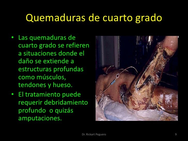 Tema ix - Quemaduras Tema ix - Quemaduras