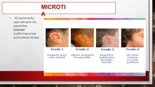 MICROTI
A
 Al nacimiento,
casi siempre los
pacientes
presentan
malformaciones
auriculares obvias
 