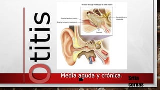 Otitis
.Media aguda y crónica.
Srita
coreas
 