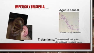 IMPÉTIGO Y ERISIPELA
Agente causal
Estreptococo β -hemolitico
Tratamiento:Tratamiento local y uso
de antibióticos sistémicos
 