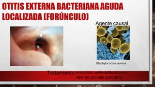 OTITIS EXTERNA BACTERIANAAGUDA
LOCALIZADA (FORÚNCULO)
Agente causal
Staphylococcus aureus
Tratamiento:Antibiótico antiestafilocócico y
rara vez drenaje quirúrgico.
 