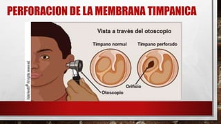 PERFORACION DE LA MEMBRANA TIMPANICA
 