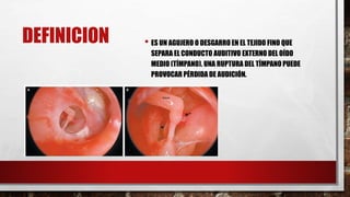 DEFINICION • ES UN AGUJERO O DESGARRO EN EL TEJIDO FINO QUE
SEPARA EL CONDUCTO AUDITIVO EXTERNO DEL OÍDO
MEDIO (TÍMPANO). UNA RUPTURA DEL TÍMPANO PUEDE
PROVOCAR PÉRDIDA DE AUDICIÓN.
 