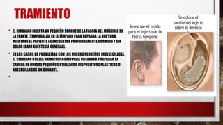 TRAMIENTO
• EL CIRUJANO INJERTA UN PEQUEÑO PARCHE DE LA FASCIA DEL MÚSCULODE
LA FRENTE (TEMPORALIS) EN EL TÍMPANO PARA REPARAR LA RUPTURA,
MIENTRAS EL PACIENTE SE ENCUENTRA PROFUNDAMENTE DORMIDO Y SIN
DOLOR (BAJO ANESTESIA GENERAL).
• EN LOS CASOS DE PROBLEMAS CON LOS HUESOS PEQUEÑOS (HUESECILLOS),
EL CIRUJANO UTILIZA UN MICROSCOPIO PARA OBSERVAR Y REPARAR LA
CADENA DE HUESOS PEQUEÑOS UTILIZANDO DISPOSITIVOS PLÁSTICOS O
HUESECILLOS DE UN DONANTE.
•
 