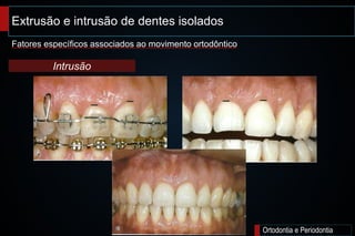 Extrusão e intrusão de dentes isolados;
Ortodontia e Periodontia
Fatores específicos associados ao movimento ortodôntico
Intrusão
 