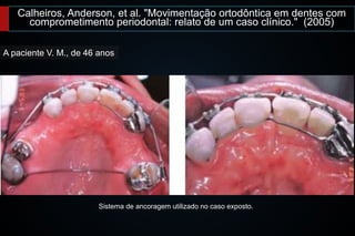 Calheiros, Anderson, et al. "Movimentação ortodôntica em dentes com
comprometimento periodontal: relato de um caso clínico." (2005)
A paciente V. M., de 46 anos
Sistema de ancoragem utilizado no caso exposto.
 