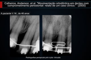 Calheiros, Anderson, et al. "Movimentação ortodôntica em dentes com
comprometimento periodontal: relato de um caso clínico." (2005)
A paciente V. M., de 46 anos
Radiografias periapicais pré e pós- intrusão
 