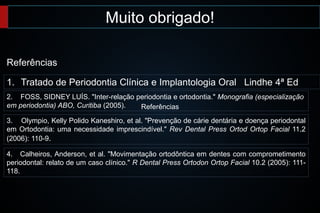 4. Calheiros, Anderson, et al. "Movimentação ortodôntica em dentes com comprometimento
periodontal: relato de um caso clínico." R Dental Press Ortodon Ortop Facial 10.2 (2005): 111-
118.
3. Olympio, Kelly Polido Kaneshiro, et al. "Prevenção de cárie dentária e doença periodontal
em Ortodontia: uma necessidade imprescindível." Rev Dental Press Ortod Ortop Facial 11.2
(2006): 110-9.
2. FOSS, SIDNEY LUÍS. "Inter-relação periodontia e ortodontia." Monografia (especialização
em periodontia) ABO, Curitiba (2005).
1. Tratado de Periodontia Clínica e Implantologia Oral Lindhe 4ª Ed
Muito obrigado!
Referências
Referências
 