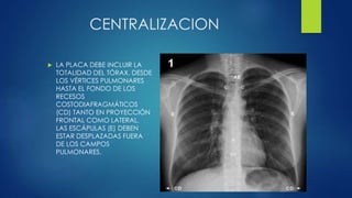 CENTRALIZACION
 LA PLACA DEBE INCLUIR LA
TOTALIDAD DEL TÓRAX, DESDE
LOS VÉRTICES PULMONARES
HASTA EL FONDO DE LOS
RECESOS
COSTODIAFRAGMÁTICOS
(CD) TANTO EN PROYECCIÓN
FRONTAL COMO LATERAL.
LAS ESCÁPULAS (E) DEBEN
ESTAR DESPLAZADAS FUERA
DE LOS CAMPOS
PULMONARES.
 
