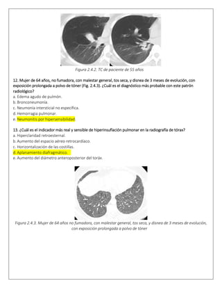 Figura 2.4.2. TC de paciente de 55 años  
12. Mujer de 64 años, no fumadora, con malestar general, tos seca, y disnea de 3 meses de evolución, con
exposición prolongada a polvo de tóner (Fig. 2.4.3). ¿Cuál es el diagnóstico más probable con este patrón
radiológico? 
a. Edema agudo de pulmón.
b. Bronconeumonía.  
c. Neumonía intersticial no específica.  
d. Hemorragia pulmonar.  
e. Neumonitis por hipersensibilidad.  
13. ¿Cuál es el indicador más real y sensible de hiperinsuflación pulmonar en la radiografía de tórax?
a. Hiperclaridad retroesternal.  
b. Aumento del espacio aéreo retrocardíaco.  
c. Horizontalización de las costillas.  
d. Aplanamiento diafragmático.  
e. Aumento del diámetro anteroposterior del toráx.
 
Figura 2.4.3. Mujer de 64 años no fumadora, con malestar general, tos seca, y disnea de 3 meses de evolución,
con exposición prolongada a polvo de tóner  
 