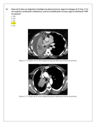 10. Mujer de 62 años con diagnóstico histológico de adenocarcinoma. Según los hallazgos de TC (Fig. 2.7.5),
con respecto a la afectación mediastínica, ¿cuál es la estadificación correcta, según la clasificación TNM
(7a edición)?  
a. N0.
b. N1.
c. N2.
d. N3.
e. Nx.  
Figura 2.7.4. Mujer de 57 años diagnosticada de adenocarcinoma de pulmón.
Figura 2.7.5. Mujer de 62 años diagnosticada de adenocarcinoma de pulmón.
 