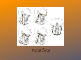 Incisões
 
