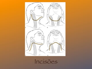 Incisões
 