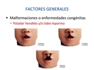 FACTORES	
  GENERALES	
  
§  Malformaciones	
  o	
  enfermedades	
  congénitas	
  
ú  Paladar	
  hendido	
  y/o	
  labio	
  leporino	
  
 