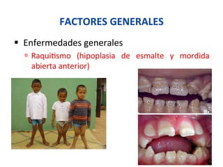 FACTORES	
  GENERALES	
  
§  Enfermedades	
  generales	
  
ú  Raqui0smo	
   (hipoplasia	
   de	
   esmalte	
   y	
   mordida	
  
abierta	
  anterior)	
  
 