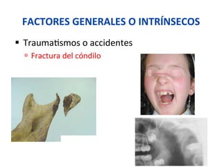 FACTORES	
  GENERALES	
  O	
  INTRÍNSECOS	
  
§  Trauma0smos	
  o	
  accidentes	
  
ú  Fractura	
  del	
  cóndilo	
  
	
  
 