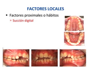 FACTORES	
  LOCALES	
  
§  Factores	
  proximales	
  o	
  hábitos	
  
ú  Succión	
  digital	
  
 