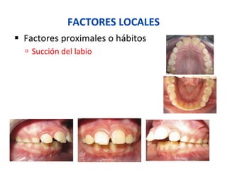 FACTORES	
  LOCALES	
  
§  Factores	
  proximales	
  o	
  hábitos	
  
ú  Succión	
  del	
  labio	
  
 