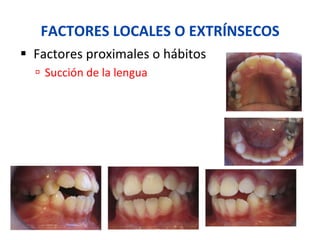 FACTORES	
  LOCALES	
  O	
  EXTRÍNSECOS	
  
§  Factores	
  proximales	
  o	
  hábitos	
  
ú  Succión	
  de	
  la	
  lengua	
  
 
