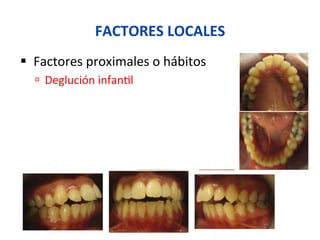 FACTORES	
  LOCALES	
  
§  Factores	
  proximales	
  o	
  hábitos	
  
ú  Deglución	
  infan0l	
  
 