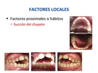 FACTORES	
  LOCALES	
  
§  Factores	
  proximales	
  o	
  hábitos	
  
ú  Succión	
  del	
  chupete	
  
 