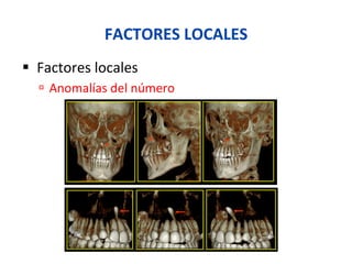 FACTORES	
  LOCALES	
  
§  Factores	
  locales	
  
ú  Anomalías	
  del	
  número	
  
 