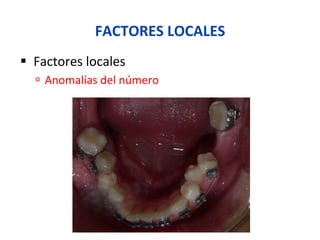 FACTORES	
  LOCALES	
  
§  Factores	
  locales	
  
ú  Anomalías	
  del	
  número	
  
 