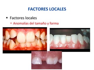 FACTORES	
  LOCALES	
  
§  Factores	
  locales	
  
ú  Anomalías	
  del	
  tamaño	
  y	
  forma	
  
 