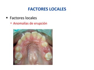 FACTORES	
  LOCALES	
  
§  Factores	
  locales	
  
ú  Anomalías	
  de	
  erupción	
  
 