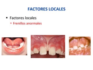 FACTORES	
  LOCALES	
  
§  Factores	
  locales	
  
ú  Frenillos	
  anormales	
  
 