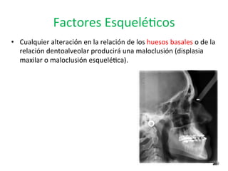 Factores	
  Esquelé0cos	
  
•  Cualquier	
  alteración	
  en	
  la	
  relación	
  de	
  los	
  huesos	
  basales	
  o	
  de	
  la	
  
relación	
  dentoalveolar	
  producirá	
  una	
  maloclusión	
  (displasia	
  
maxilar	
  o	
  maloclusión	
  esquelé0ca).	
  
 