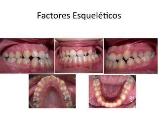 Factores	
  Esquelé0cos	
  
 
