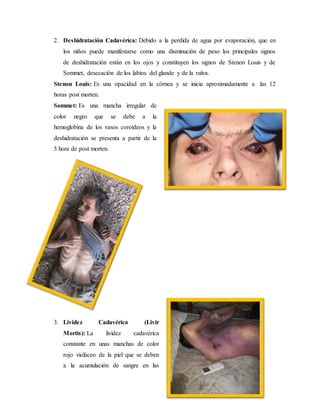 2. Deshidratación Cadavérica: Debido a la perdida de agua por evaporación, que en 
los niños puede manifestarse como una disminución de peso los principales signos 
de deshidratación están en los ojos y constituyen los signos de Stenon Louis y de 
Sommet, desecación de los labios del glande y de la vulva. 
Stenon Louis: Es una opacidad en la córnea y se inicia aproximadamente a las 12 
horas post morten. 
Sommet: Es una mancha irregular de 
color negro que se debe a la 
hemoglobina de los vasos coroideos y la 
deshidratación se presenta a partir de la 
5 hora de post morten. 
3. Lividez Cadavérica (Livir 
Mortis): La lividez cadavérica 
constante en unas manchas de color 
rojo violáceo de la piel que se deben 
a la acumulación de sangre en las 
 