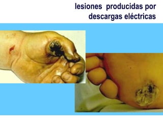 lesiones producidas por
     descargas eléctricas
 