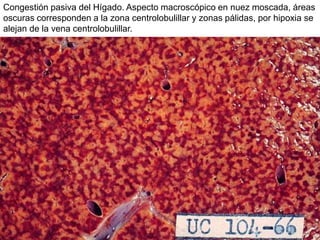 Congestión pasiva del Hígado. Aspecto macroscópico en nuez moscada, áreas
oscuras corresponden a la zona centrolobulillar y zonas pálidas, por hipoxia se
alejan de la vena centrolobulillar.
 