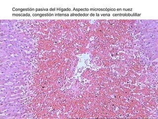 Congestión pasiva del Hígado. Aspecto microscópico en nuez
moscada, congestión intensa alrededor de la vena centrolobulillar
 