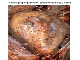 Hemorragias petequiales en el epicardio secundarias a hipoxia
 