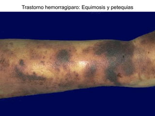Trastorno hemorragiparo: Equimosis y petequias
 
