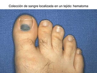 Colección de sangre localizada en un tejido: hematoma
 