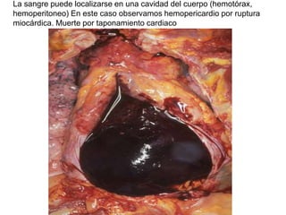 La sangre puede localizarse en una cavidad del cuerpo (hemotórax,
hemoperitoneo) En este caso observamos hemopericardio por ruptura
miocárdica. Muerte por taponamiento cardiaco
 