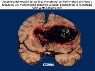 Observe la destrucción del parénquima cerebral por hemorragia secundaria a
ruptura de una malformación congénita vascular. Extensión de la hemorragia
hacia ventrículos laterales
 