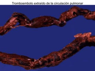 Tromboembolo extraído de la circulación pulmonar
 